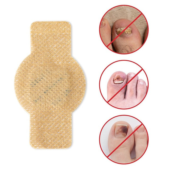 NailNex™ skuteczne leczenie grzybicy paznokci